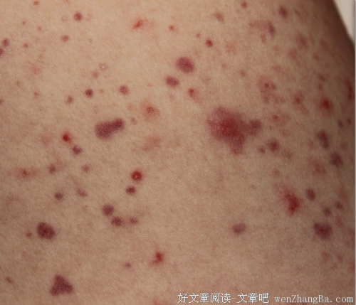 【图】啊啊啊！大腿内侧突然长了一片....该怎么办啊！！！