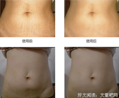 开放三胎？先看看女人生完孩子后的肚子