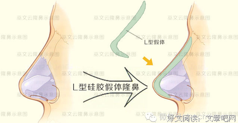 “她身上唯一值钱的，就是那18w做的鼻子。”