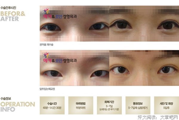 【图】怎么办？割出来的双眼皮，竟然一天比一天...