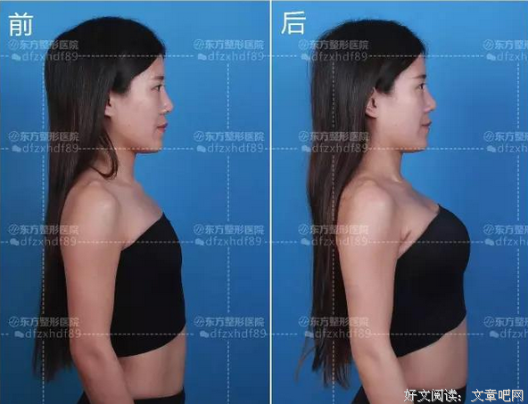 那个做了第三者的网红，来找我隆胸之谜