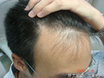 发与秃
