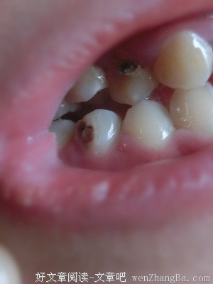 拔牙