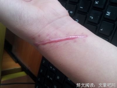 疤痕