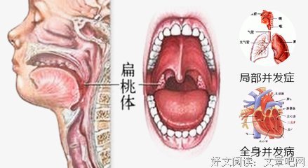 鼻喉发炎