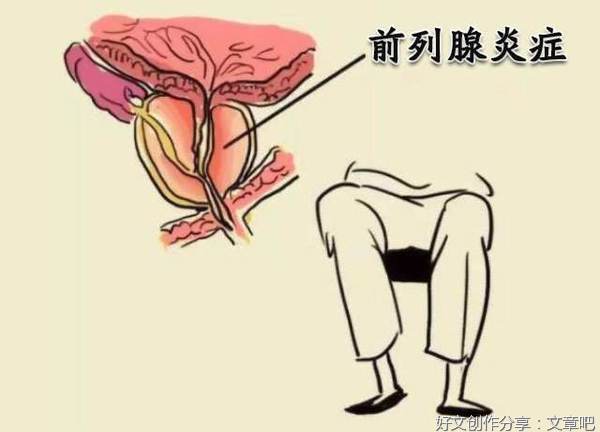 患者对慢性前列腺炎有哪些误解？