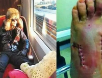 【图】连续熬夜一个月，缝了六针，直接毁容了....