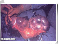 切除子宫之后，他消失了！但最终，她还是嫁给了兵哥！