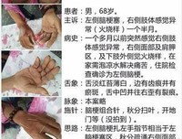 秋风一起，关节受罪！贴了睡一觉，舒服又灵活