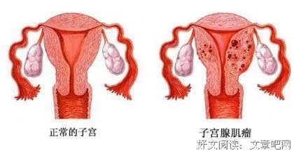 看B超单怎么来确定是子宫腺肌症？王长杰医生来指导你正确认识它