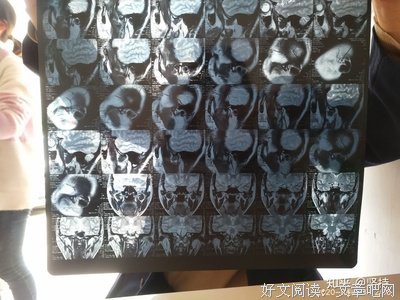 医生让回家考虑一下，我也很纠结