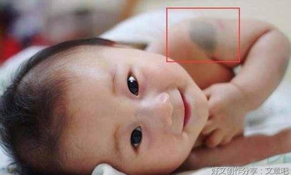 胎记