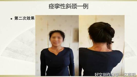 回顾2021年别人的痉挛性斜颈已恢复，展望2022年的你是否考虑治疗